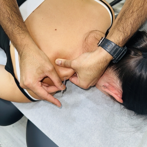 dry-needling-Retrieve-Physiotherapy-Mississauga-ON